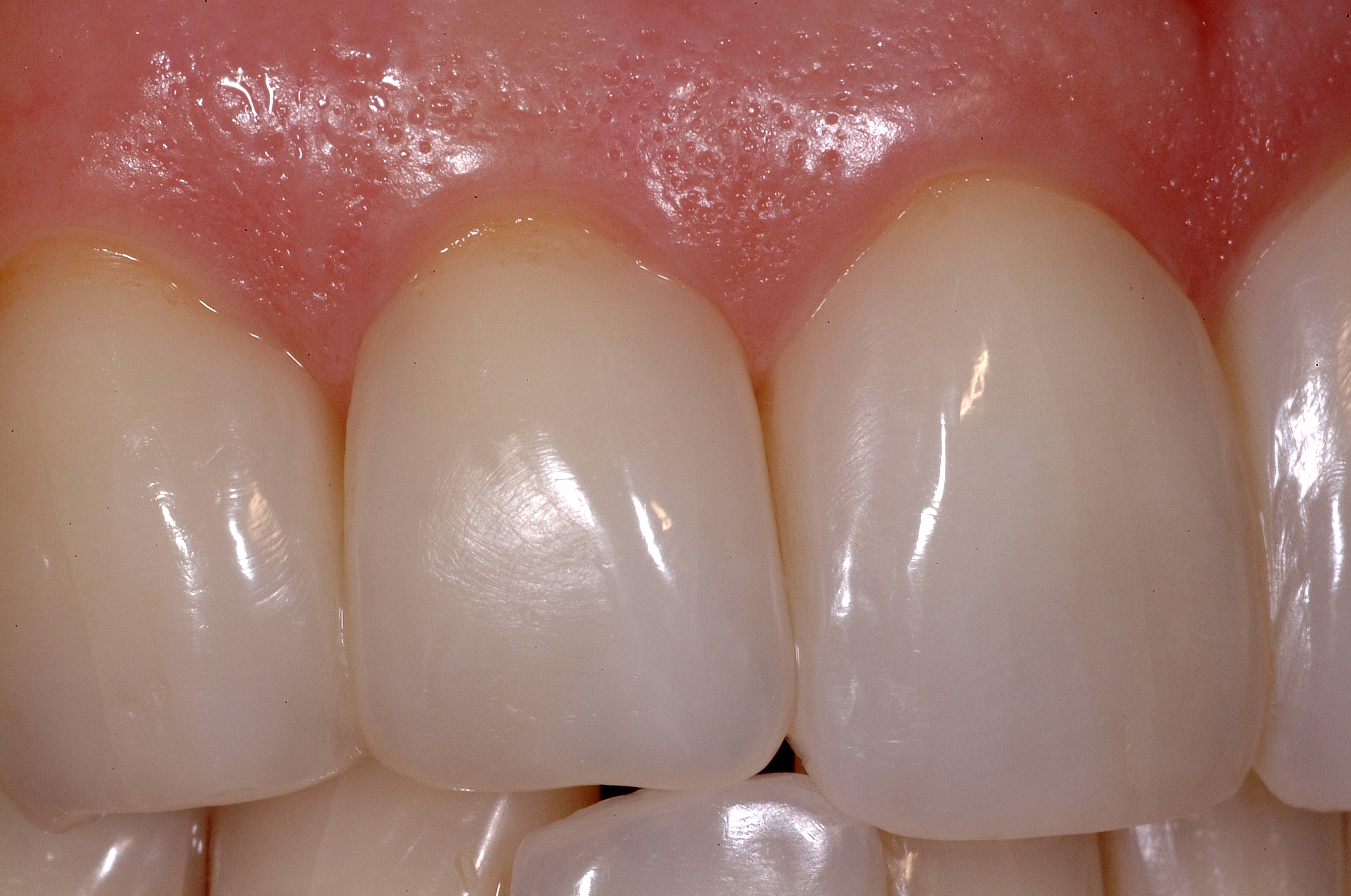 Closing the Gap in Direct Dentistry Treating Black Triangles Optident